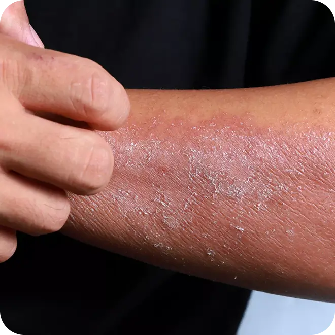 Eczema